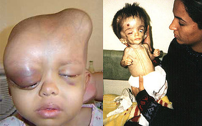 Enfants victimes de l'uranium appauvri